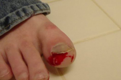 Гематома під нігтем великого пальця на нозі: як прискорити лікування?