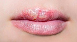 Пухирі на язику: Причини, Лікування, Пухирі на губах