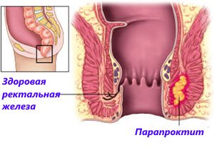Несе геморой небезпека для здоровя?