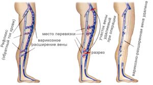 Операція з видалення варикозних вен   які існують види операцій