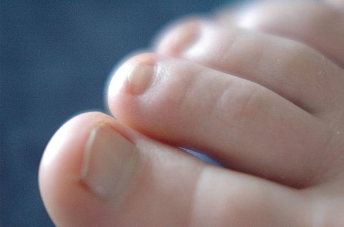 Дізнайтеся, як видалити врослий ніготь за допомогою лазера