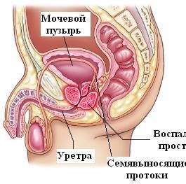 Простатит причини, симптоми і лікування
