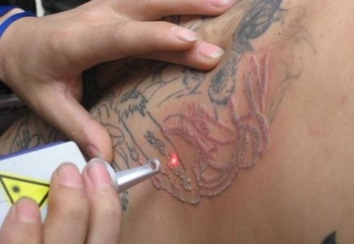 Видалення татуювань   лазером і іншими способами; виведення тату в домашніх умовах