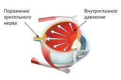 Операція при глаукомі