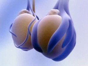 Варикоз яєчок у чоловіків або варикоцеле: симптоми, лікування, наслідки