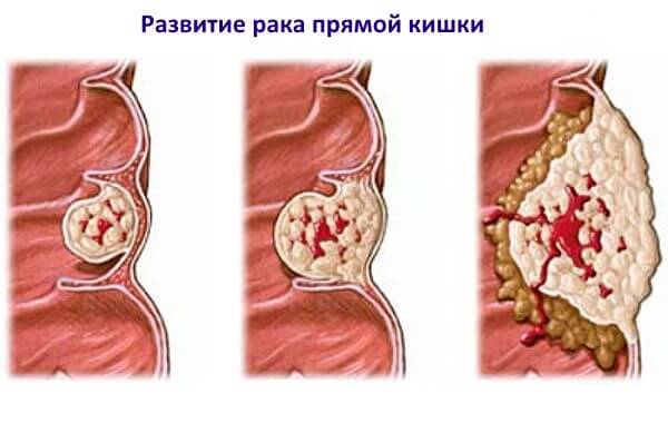 Що болить у прямій кишці?