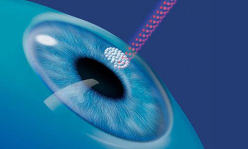 Операція на очі лазером: протипоказання, наслідки, можливі побічні ефекти (відео)