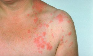 Плями на шкірі від нервів: звідки взялися, як лікувати і попередити