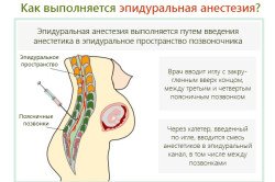 Епідуральна анестезія
