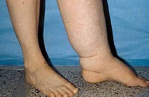 Як лікувати лімфостаз нижніх кінцівок: симптоми та причини слоновості ніг