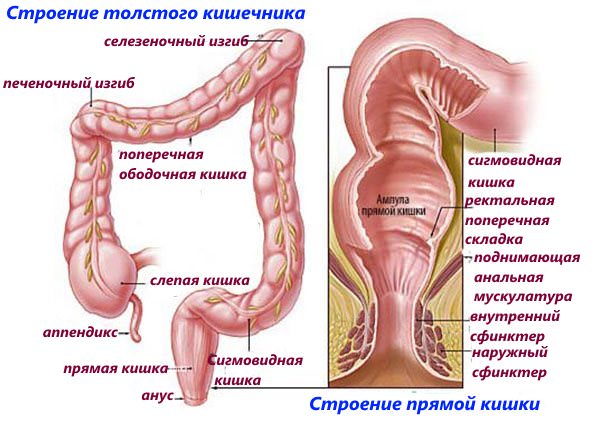 геморой
