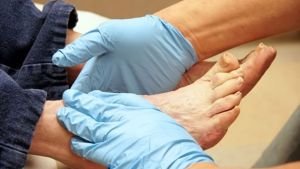 Трофічні виразки на ногах: профілактика, причини і лікування