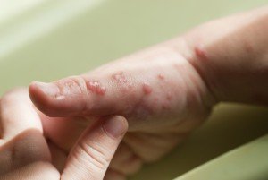 Плями на шкірі від нервів: звідки взялися, як лікувати і попередити