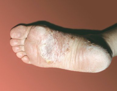 Як позбутися мозолів на пальцях ніг, стоп: чим лікувати?