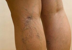 Від чого зявляються судинні зірочки на ногах: лікування, причини, симптоми