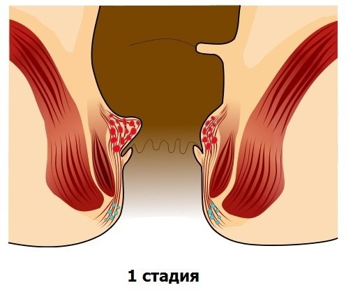 Як лікувати тромбоз зовнішнього гемороїдального вузла
