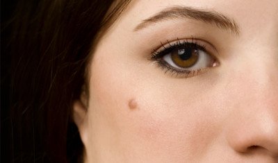 Базилома шкіри обличчя, носа: що це таке, лікування, видалення, симптоми