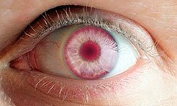 Червоний колір очей: альбінос або хворий?
