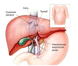 Синдром бадда кіарі (облітеруючий флебіт печінкових вен): лікування та прогноз