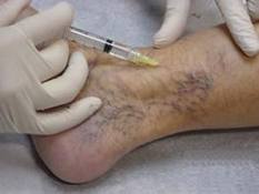 Чим небезпечний варикоз на ногах?