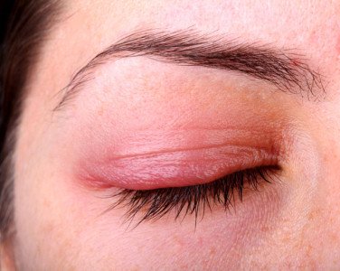 Демодекс очей (очної кліщ): симптоми і лікування на століттях, віях