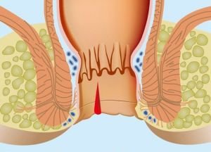 Анальний свербіж і печіння в задньому проході: причини і лікування у чоловіків і жінок