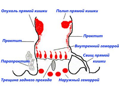 Що робити при запаленні прямої кишки?