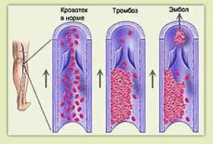 Тромбоз глибоких вен нижніх кінцівок: симптоми, лікування та реабілітація