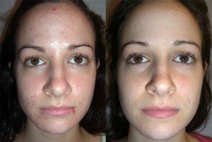 Хімічний пілінг обличчя в салоні і домашніх умовах (фото до і після, відгуки)