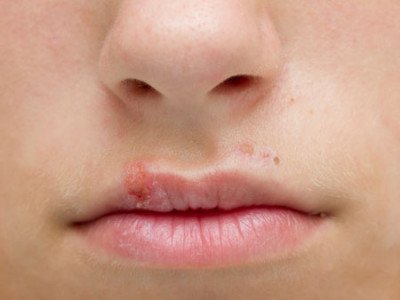 Герпес на губах   як швидко вилікувати застуду, ознаки і симптоми герпесу