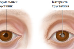 Операція по заміні кришталика ока: показання та методика проведення, реабілітація, можливі ускладнення (відео)