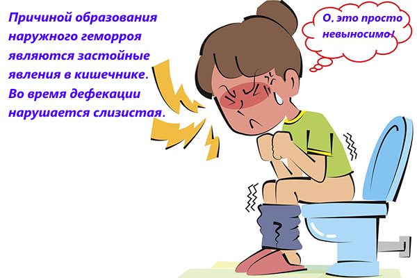 Чим характеризується поява зовнішнього геморою