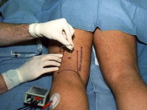 Ретикулярный варикоз нижніх кінцівок: чому необхідно лікування, методи та поради