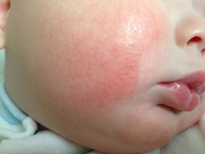 Червоні шершаві плями на тілі, обличчі у дитини, грудничка на шкірі