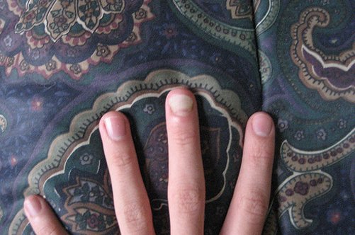 Грибок під нігтями на руках: як його вилікувати?