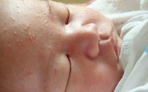 У новонародженого на обличчі зявилися білі прищики. Як лікувати їх?
