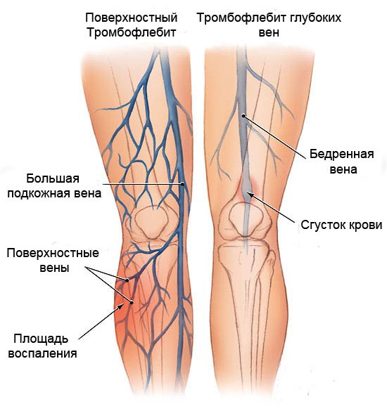 Тромбофлебіт на ногах: симптоми і лікування