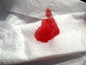 Кров на туалетному папері після спорожнення (дефекації): причини, що робити