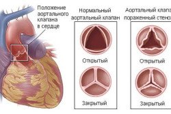 Операція стентування судин серця: показання, післяопераційна реабілітація (відео)