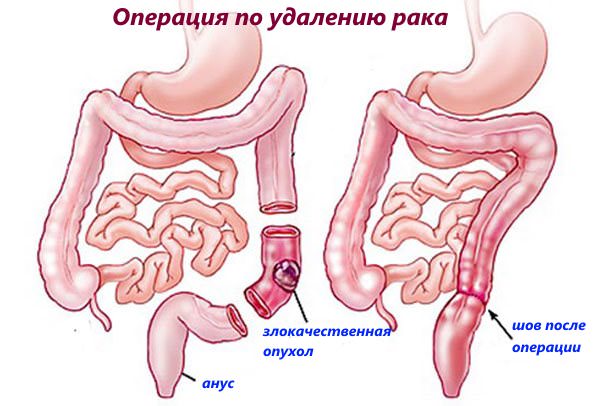 Показники виживаності при раку прямої кишки