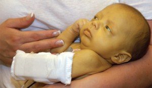 Жовтянка у новонародженої дитини: чи можливе лікування в домашніх умовах?
