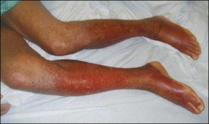 Застійний дерматит: причини, симптоми і лікування