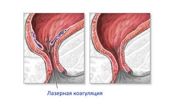 Геморой при вагітності можна і потрібно лікувати