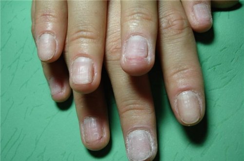 Які можуть бути наслідки нарощування нігтів?