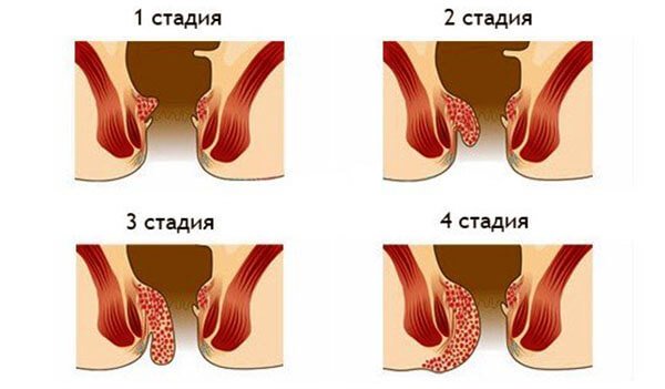 Чи можна вилікувати геморой народними засобами?