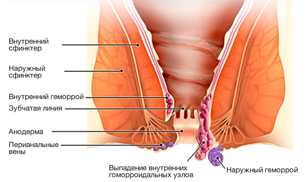 Що робити якщо лопнув геморой