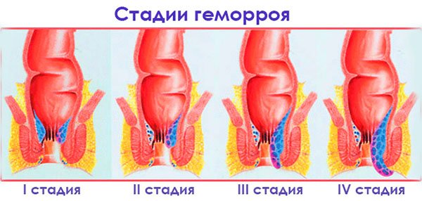 Як розпізнати внутрішній геморой?