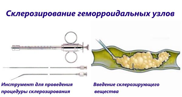 Ефективний метод боротьби з гемороєм — склеротерапія