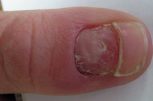 Пустоти під нігтями: причини появи і лікування