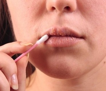 Герпес на губах   симптоми захворювання; профілактика і лікування народними засобами